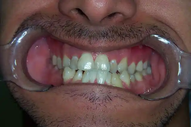 yellowing of teeth