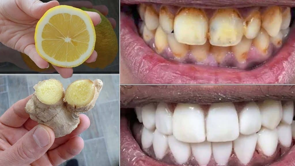 Brighten Your Smile: 5 Natural Ways to Remove Teeth Stains