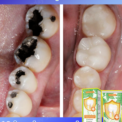 Best-selling, scientific fluoride repairs cavities,